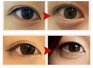 玻尿酸一打就是个无底洞,打玻尿酸现在是不是还挺普遍的