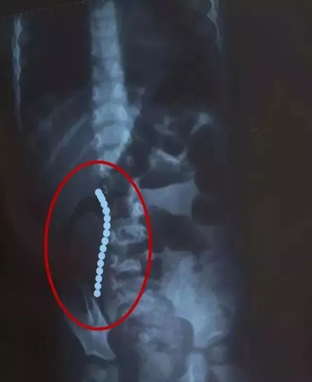 吸铁石不小心让孩子吞了有危害吗,熊孩子吸铁石