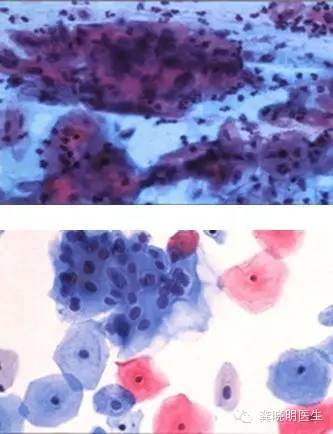 宫颈刮片报告,宫颈刮片检查报告