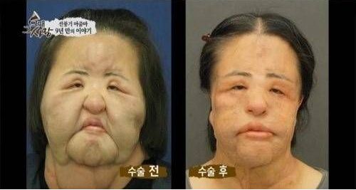 韩国整容毁容女逝去,整容电风扇大妈