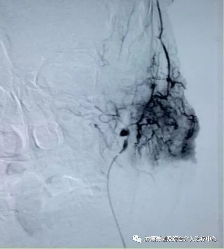 运城市第一医院肿瘤科咋样,运城第一医院治疗肿瘤怎么样