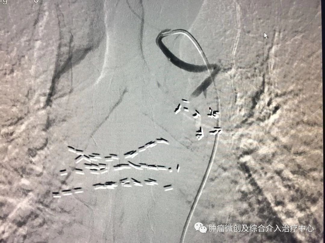 运城第一医院肿瘤介入科专家,运城市第一医院介入科专家
