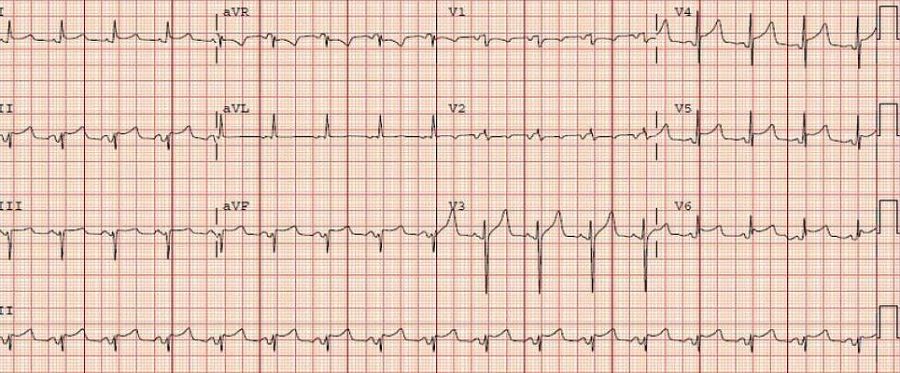 干货：急性心包炎的临床诊疗要点
