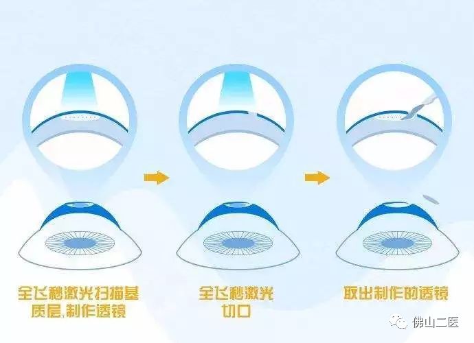 激光近视手术需要多少钱,做近视手术后需要注意事项