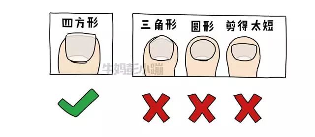 撕倒刺指甲化脓掉了,拔倒刺后指甲脱落