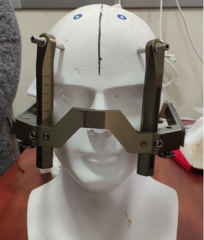 赞！重庆三博江陵医院成功开展脑干占位立体定向活检术！