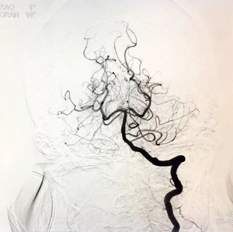 柳暗花明专栏｜栓塞颅内动脉瘤时微导管无法穿过LVIS支架网眼怎么办