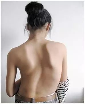 父母必看系列青少年心理健康,家长发现脊柱侧弯