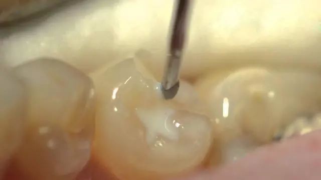 预防龋齿最有效最经济的方法,学习了解预防龋齿最有效的方法