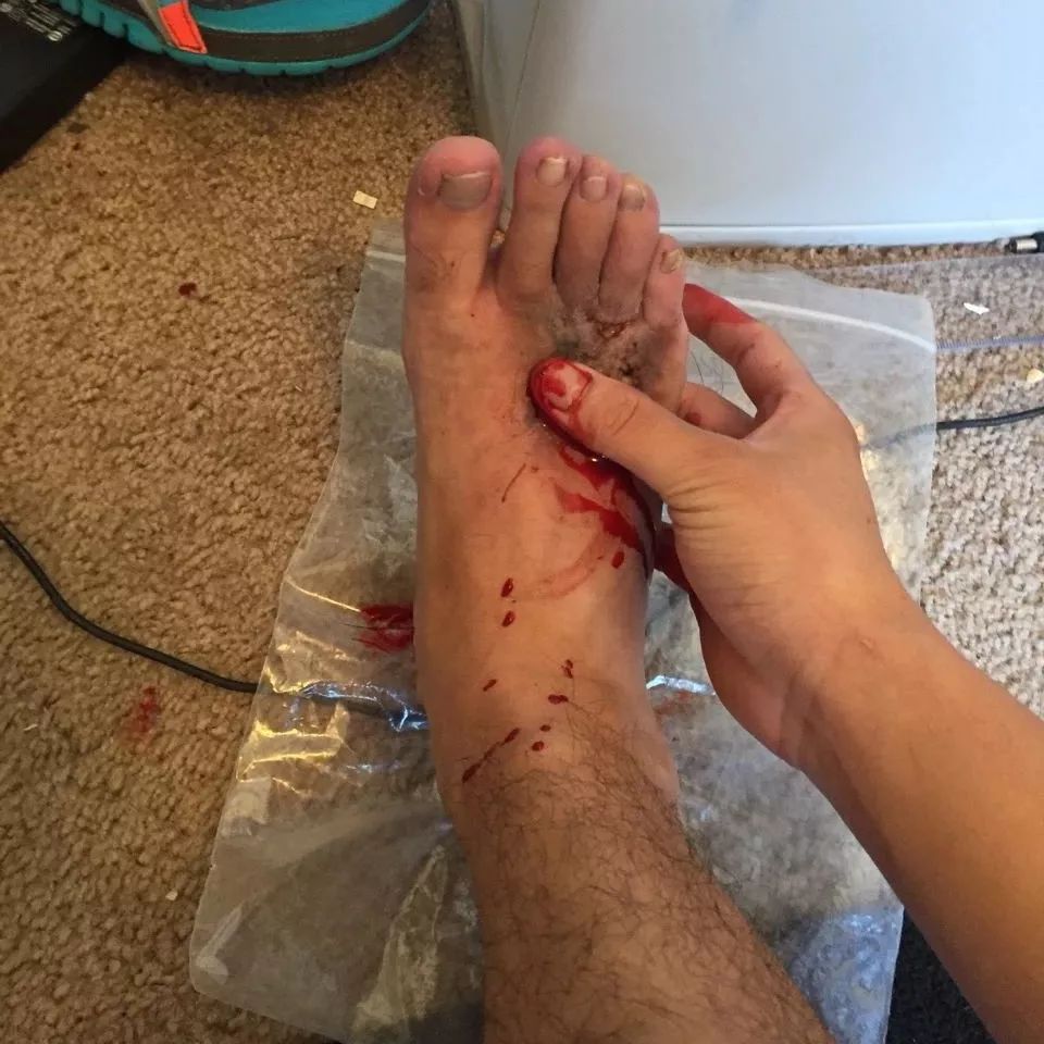 俄罗斯留学生骨折截肢,留学生意外被截肢