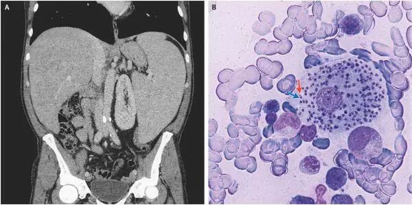 利什曼病的病因,利什曼病确诊