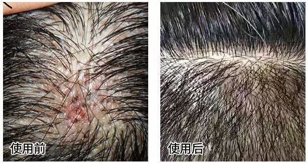 3天不洗头头皮特别多,3天不洗头头皮好臭