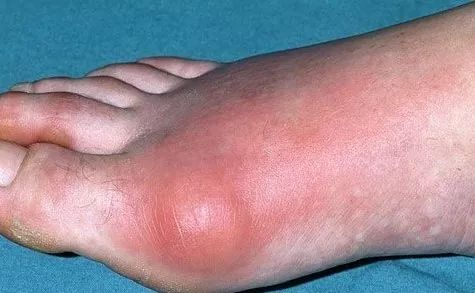 19岁小伙饮料当水喝喝出糖尿病,15岁男孩把可乐当水喝睁眼