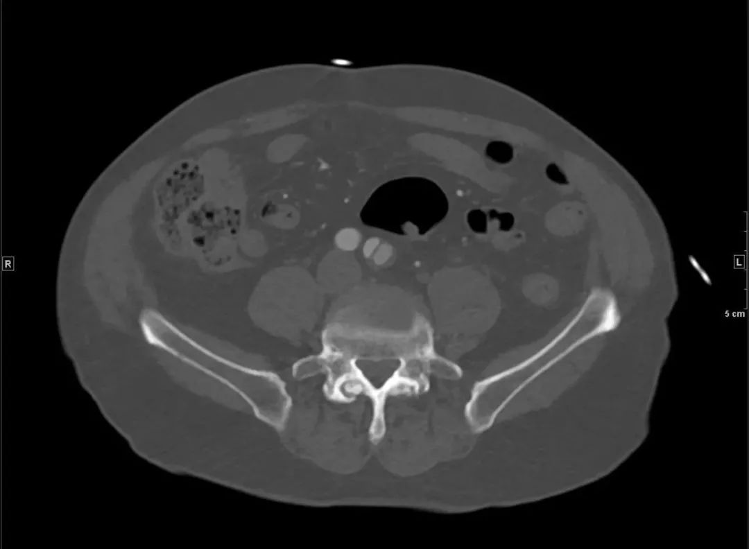 心冠动脉夹层能治愈吗,夹层动脉血管破裂症状