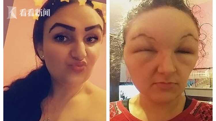18岁女子染发剂过敏脸肿大一倍像“怪物”眼睛两天睁不开