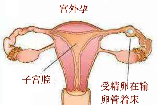 找错位置的受精卵——宫外孕