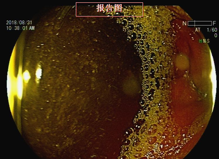 消化道支架置入术,消化道梗阻支架怎么放