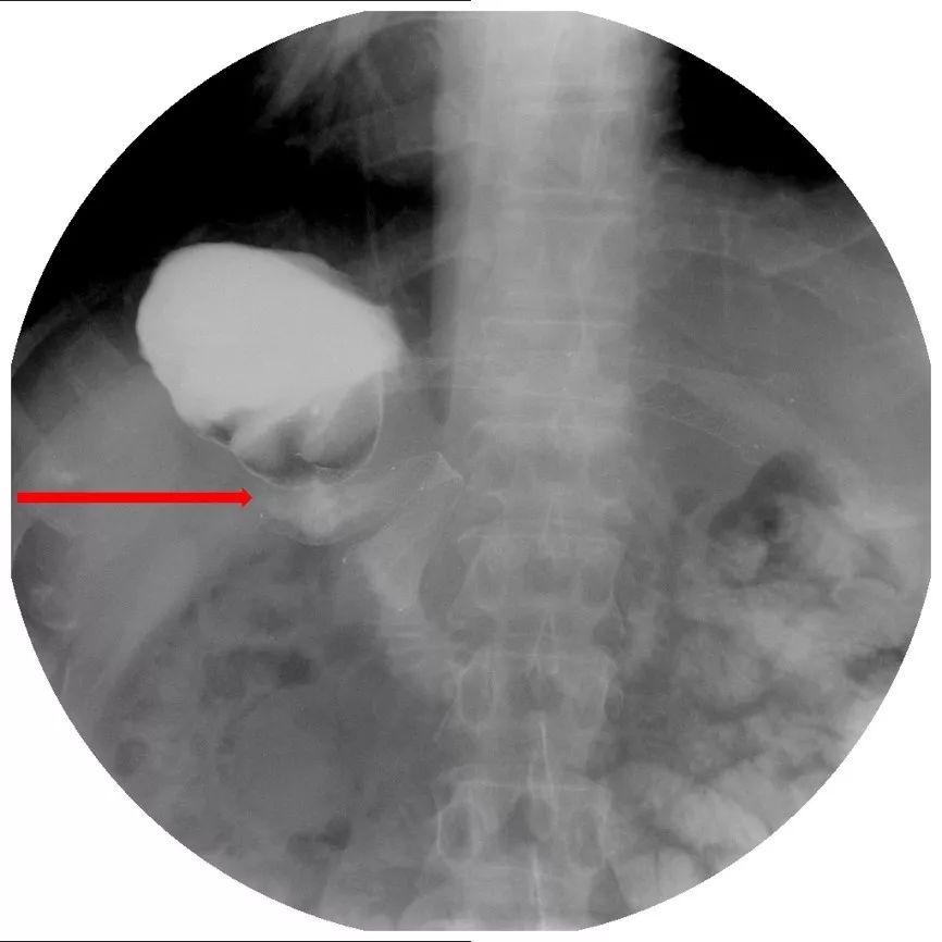 消化道支架置入术,消化道梗阻支架怎么放