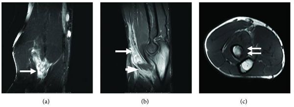 外国男子肱二头肌腱断裂,肱二头肌腱断裂原因为何