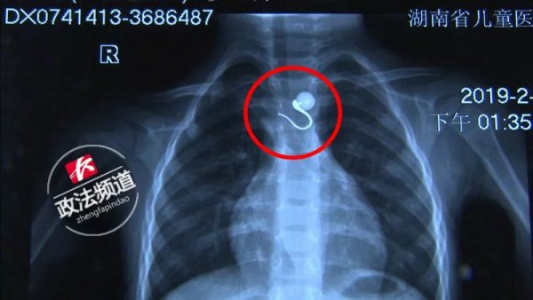 妈妈给孩子换尿布发现嘴里一个洞,儿童换尿布时吞耳环