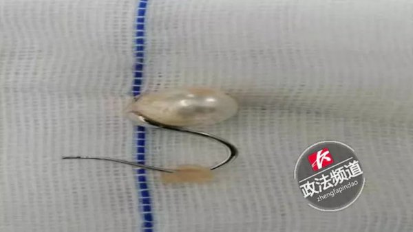 妈妈给孩子换尿布发现嘴里一个洞,儿童换尿布时吞耳环