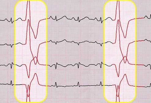 胃病会导致心悸吗,什么原因会心悸心慌