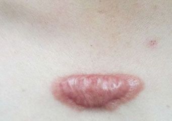 女儿摔破了头流血怎么办,女儿摔破头了我很自责