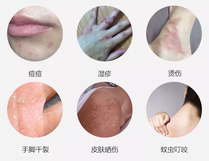 湿疹晒伤后抹什么药膏,日晒皮炎湿疹用什么止痒