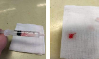 picc预防堵管原因及处理方法,picc封管一次没用肝素会堵吗