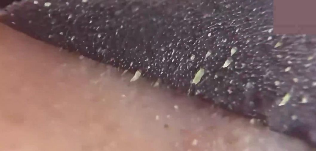 辣眼睛，有人用它吸出一整年的黑头，看完我果断下单了！