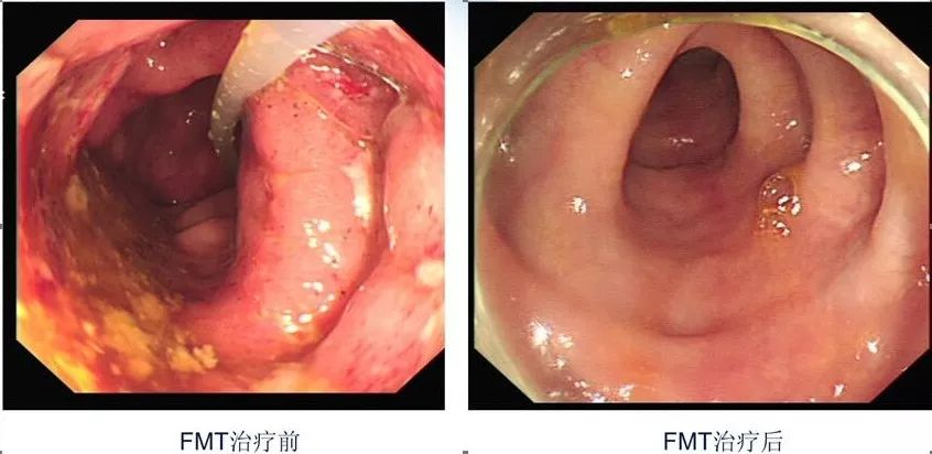 粪菌移植治疗溃疡性结肠炎,粪菌移植治疗溃疡性结肠炎费用
