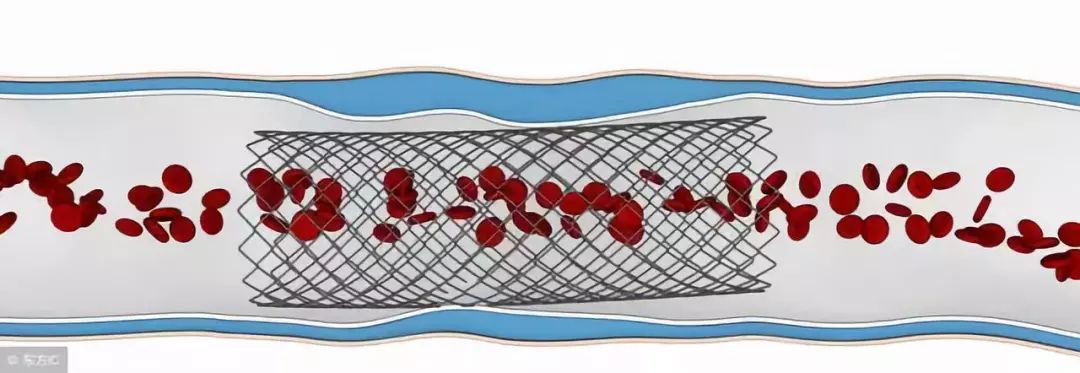 急性心肌梗死院前急救的急救措施,中医治疗急性心肌梗死的急救方法