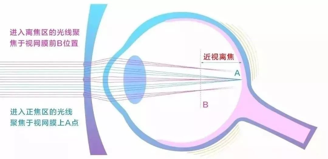 近视眼镜发展使用了哪些新技术,近视最新突破