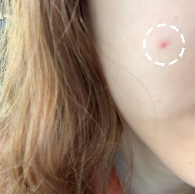 十大好用的祛痘印产品,真实有效的几款祛痘印神器