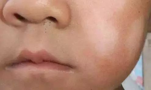 宝宝得了湿疹皮炎怎么办,婴儿特殊类型的湿疹以及皮炎