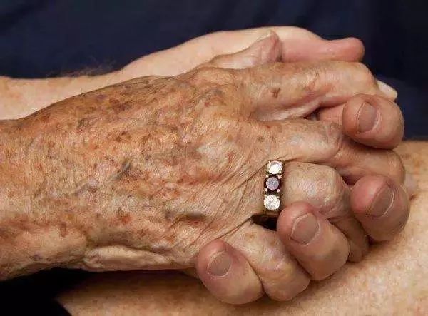 中年妇女如何预防脸上长老年斑,五十岁怎样预防才能不长老年斑