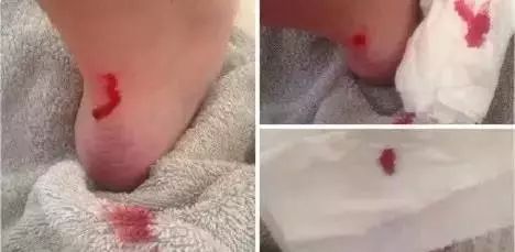 防磨脚神器隐形贴,防磨脚神器磨脚膏