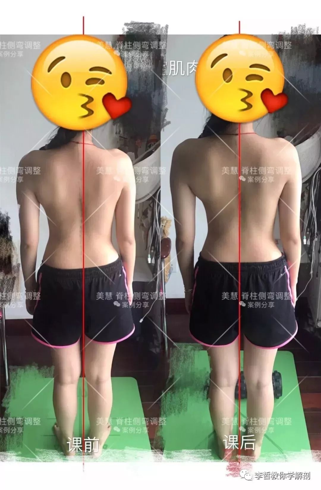 腰间盘突出脊柱侧弯康复训练,螺旋肌肉链训练治疗腰椎间盘突出