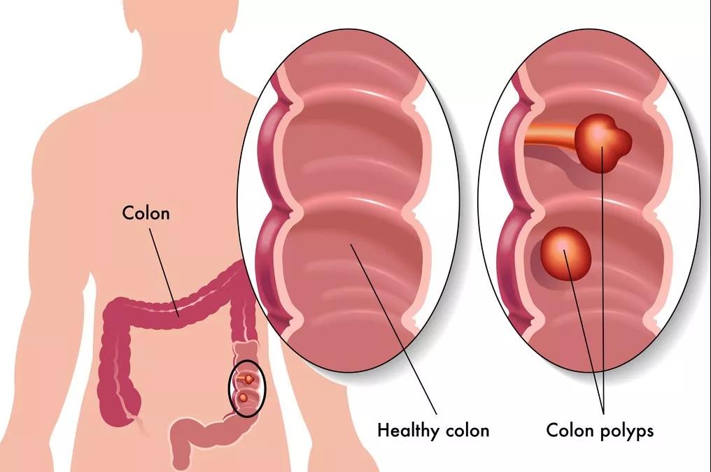 为什么切了息肉，还是会患癌？因为切息肉有时就像割韭菜……