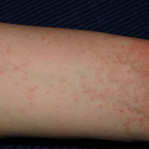 痒痒痒！疥螨会在皮肤内挖掘隧道