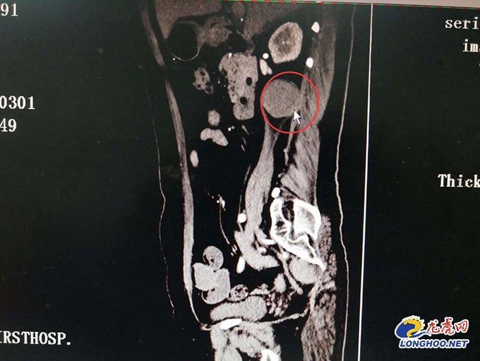 女人腰肌劳损会导致夜间腰痛吗,女子腰背疼以为旧病复发
