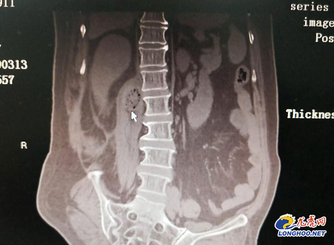 女人腰肌劳损会导致夜间腰痛吗,女子腰背疼以为旧病复发