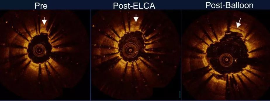 oct閽欏寲鐥呭彉,cit2019灞曚細瑙嗛