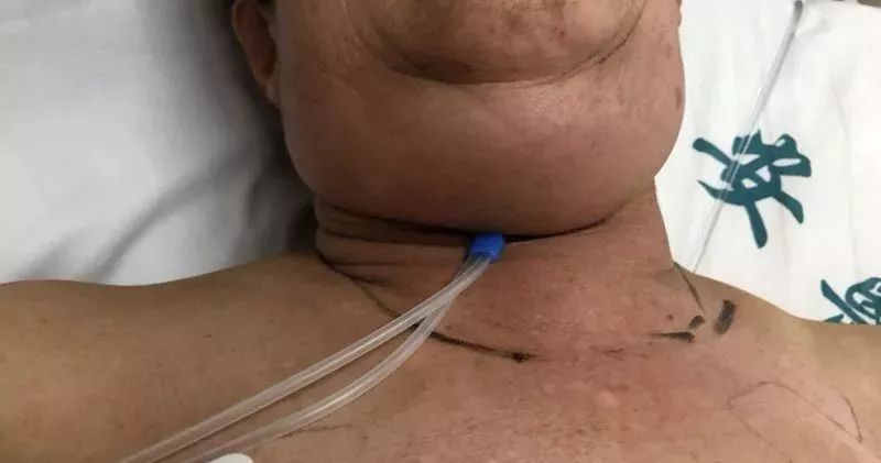 女子抠痘痘住进icu,一女子抠鼻屎抠出恶性肿瘤