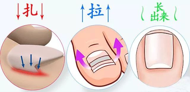 趾甲扎进肉里了，一碰就痛？用它一贴，1分钟止痛，趾甲往外长，再也不扎痛了！