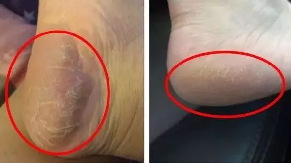 足部护理加长加热脚套,足部护理脚趾套品牌