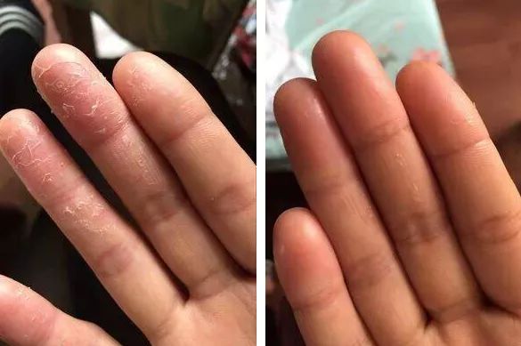 脚后跟套上这个“*钟金**罩”夏季穿鞋嫩到反光！干裂、老茧、死皮都没了！