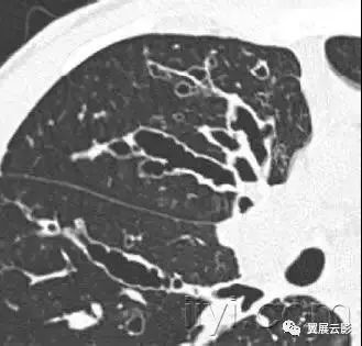 胸部解剖及常见疾病影像表现,胸部影像学基础知识