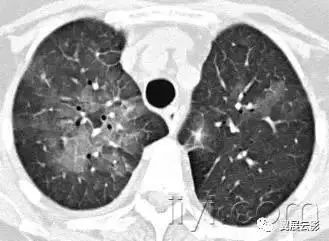 胸部解剖及常见疾病影像表现,胸部影像学基础知识