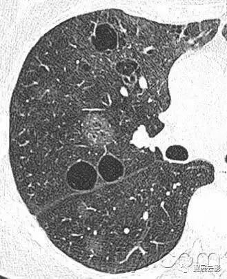 胸部解剖及常见疾病影像表现,胸部影像学基础知识